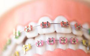 Metal braces - Boley Braces