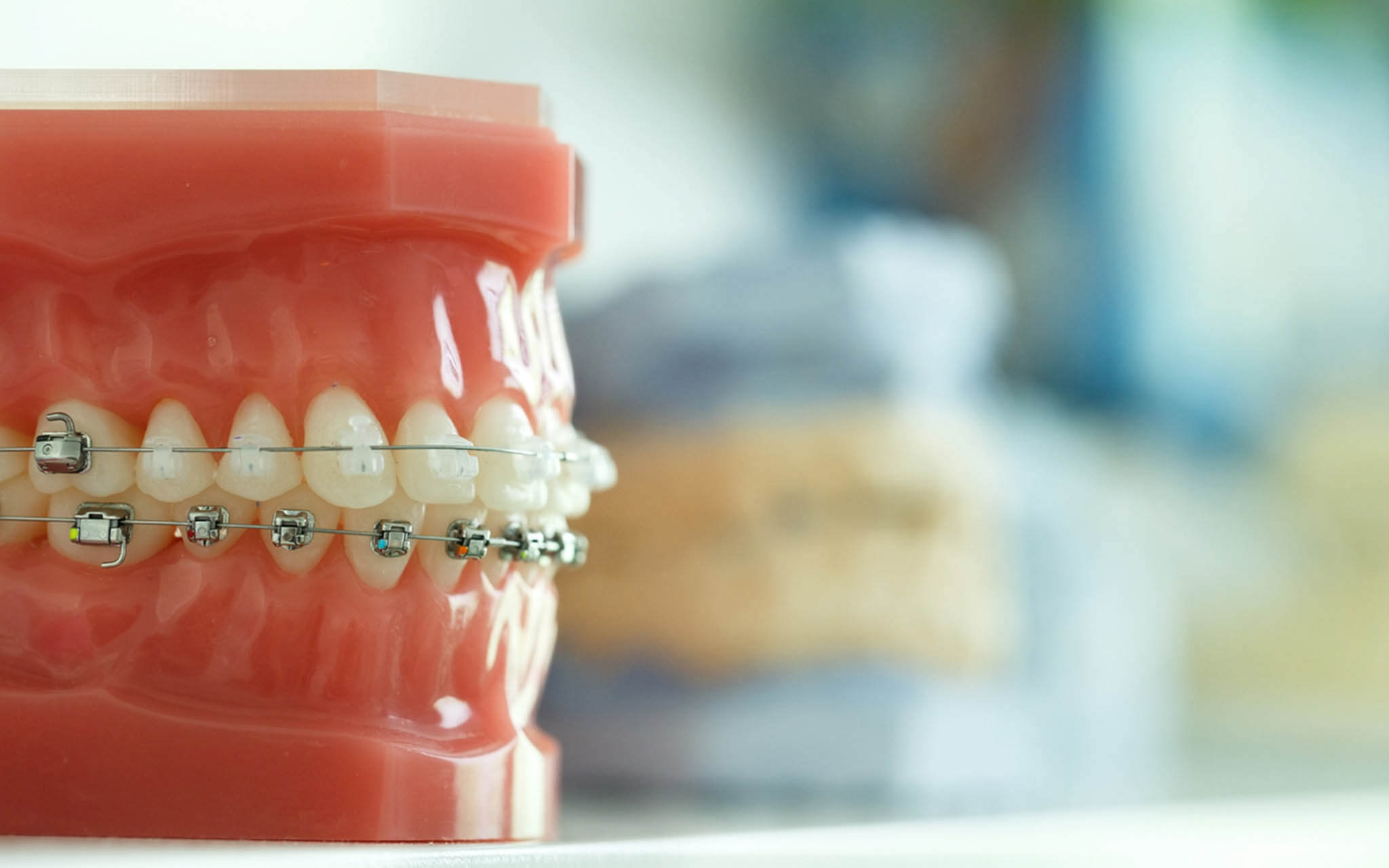 Clear and metal braces - Boley Braces