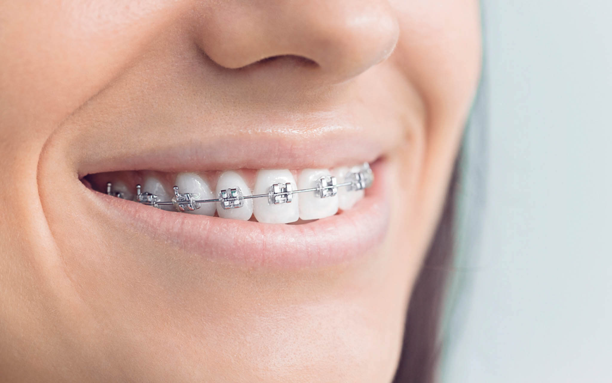 How Much Do Invisible Braces Cost in Australia?