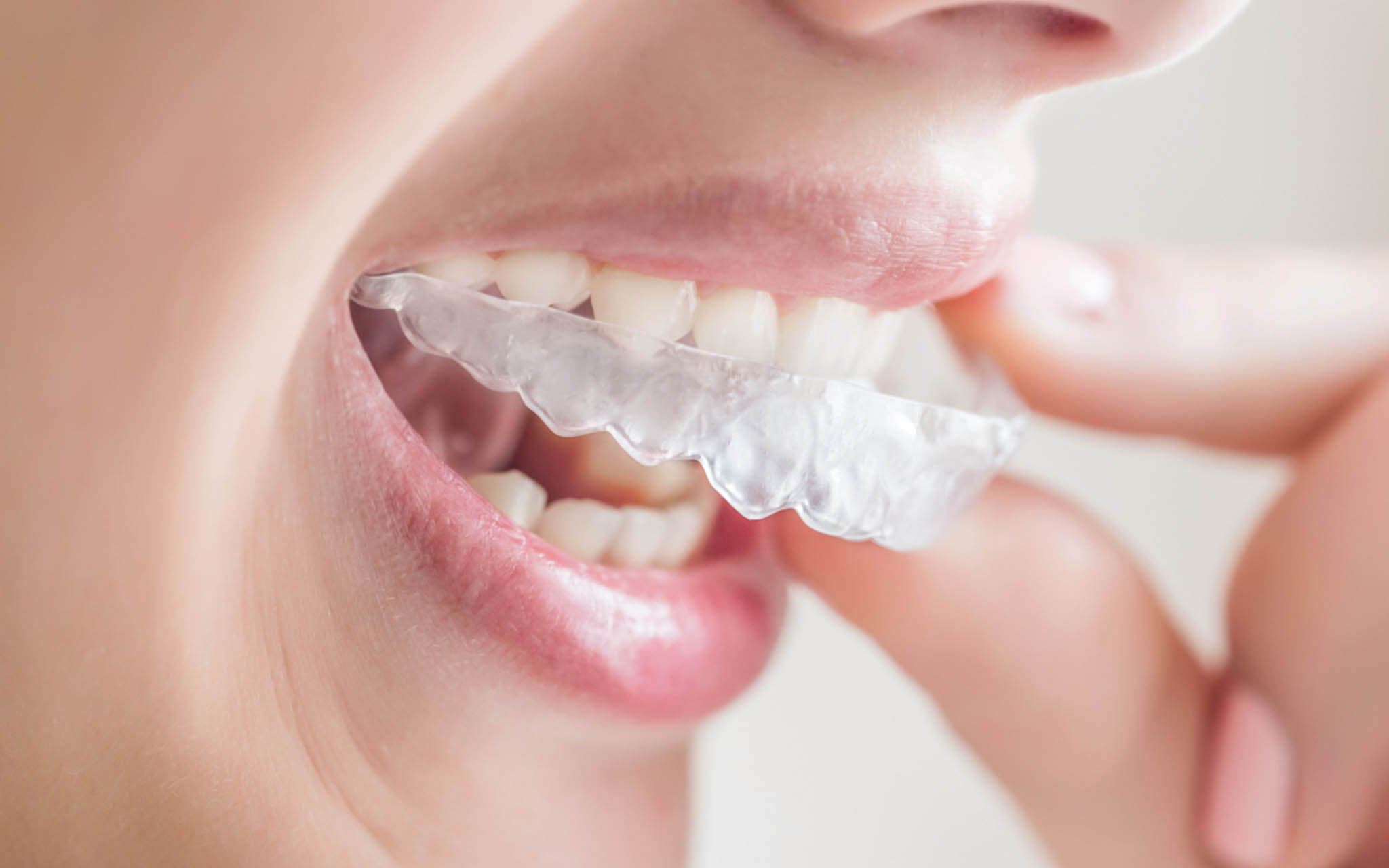 invisalign braces