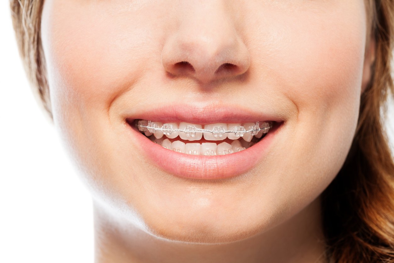 Metal, Clear or Invisible Braces, Harrison & Cincinnati, OH