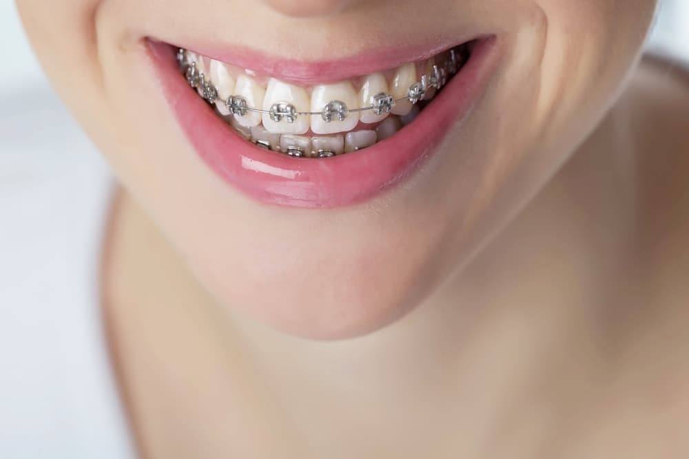 Clear Braces Holliston, MA, Adult Orthodontics