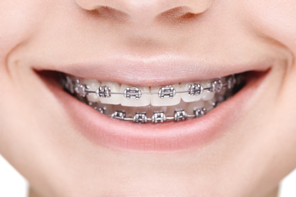 white metal braces